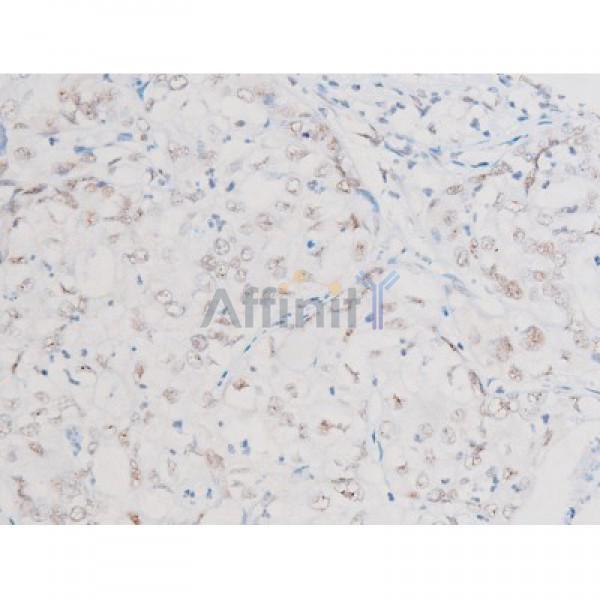 Phospho-NF-kB p65 (Ser281) Antibody - AF3393 at 1/200 staining Human liver cancer tissue sections by IHC-P.
